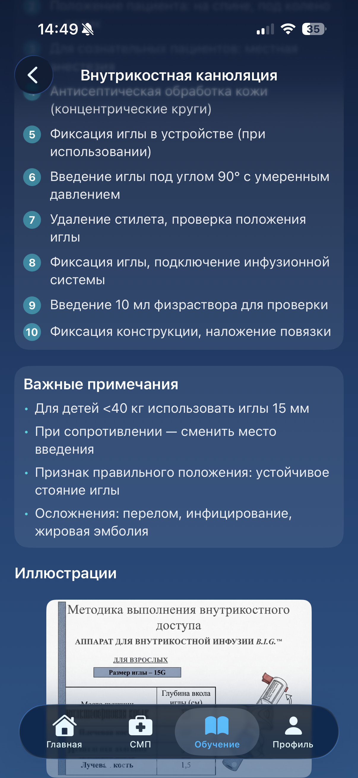 Техника внутрикостной канюляции